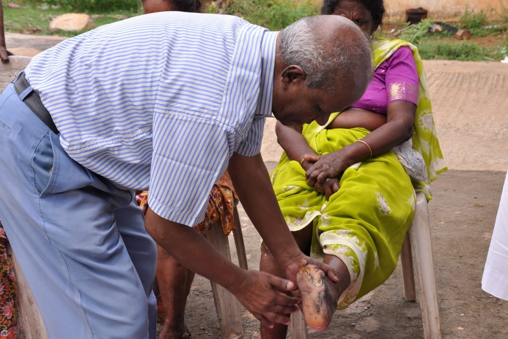 Patients with leprosy often need ongoing treatment to help them manage their disease.